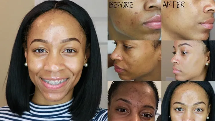 effective Acne Treatment ORIGINAL Mario Badescu Drying Lotion